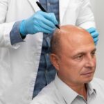 Why Choose a Hair Transplant Over Non-Surgical Options?